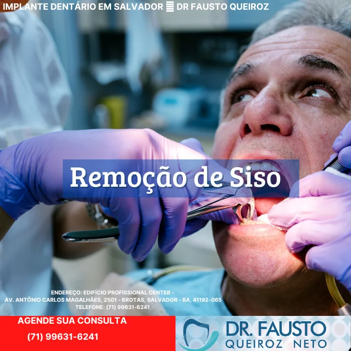 Remoção de Siso em Salvador - Dentista em Salvador - Extração de Siso (1) (1)